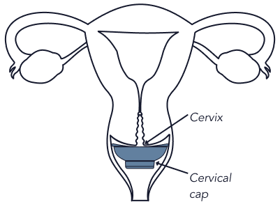 ICI_reproductive_system.png